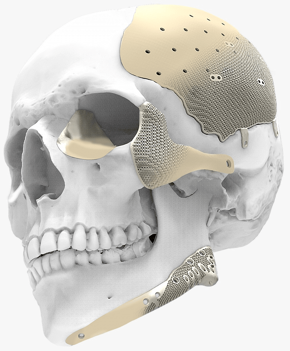 CAD/CAM guided surgical device work